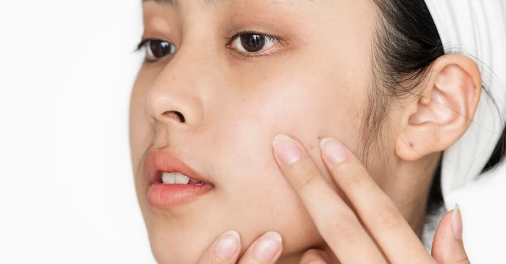 Posso fazer peeling no verão?