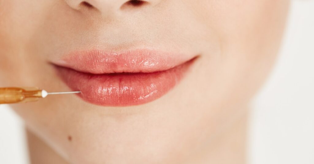 Quanto tempo dura o preenchimento labial? O que influencia o resultado