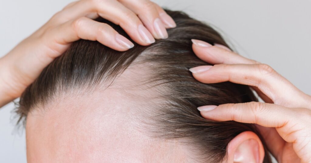 Tipos de alopecia: como identificar e quando buscar ajuda
