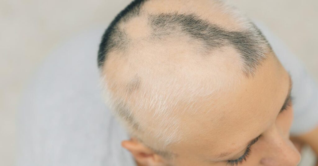 Tratamento da alopecia areata: opções seguras e acompanhamento adequado