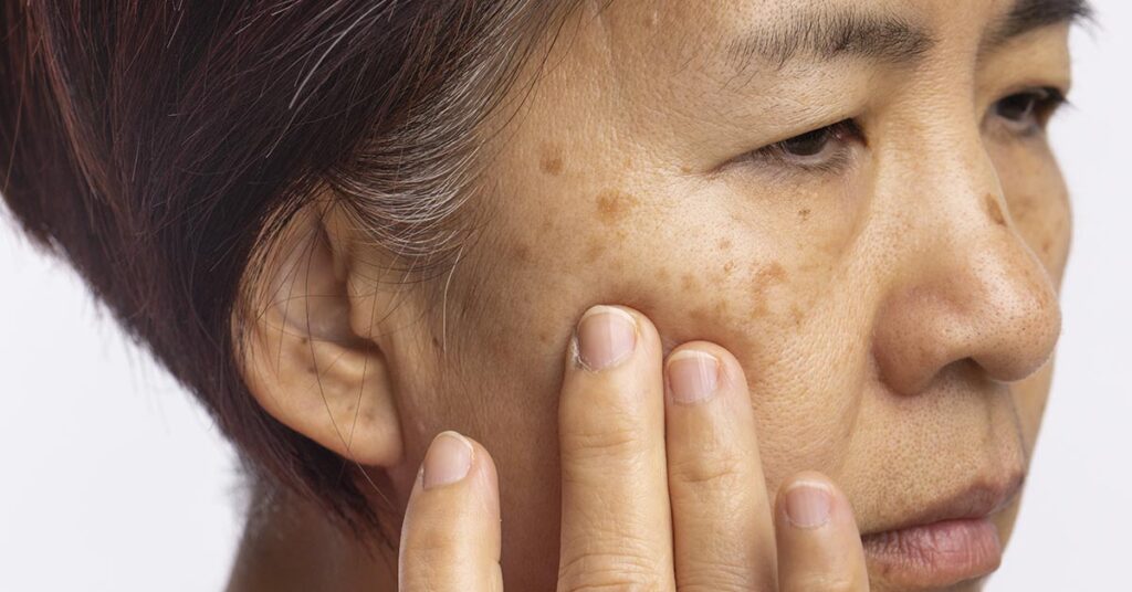 Como tratar o melasma no rosto: estratégias combinadas