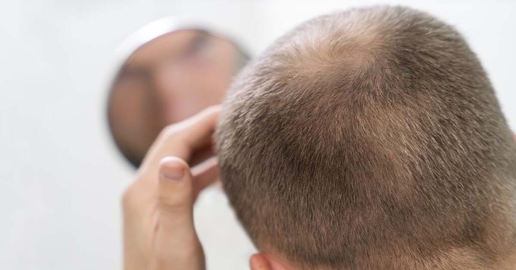 Alopecia androgenética: sinais iniciais, causas e diagnóstico